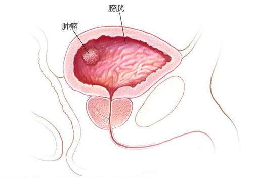 福州御和堂：膀胱癌的四大表现