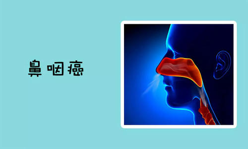 福州中医治疗鼻咽癌去哪