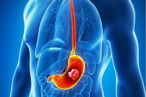 胃癌常识及如何进行科学预防